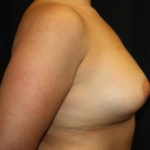 Breast Implant Exchange Before & After Patient #26656