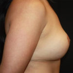 Breast Implant Exchange Before & After Patient #26656