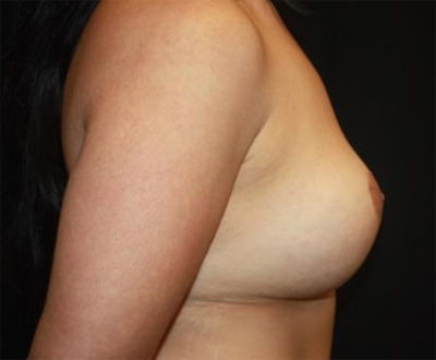 Breast Implant Exchange Before & After Patient #26656