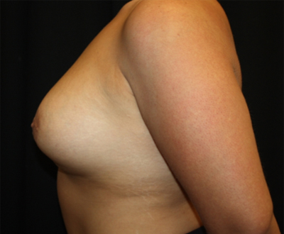 Breast Implant Exchange Before & After Patient #26656
