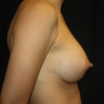 Breast Augmentation - Round Silicone Implants Before & After Patient #25608