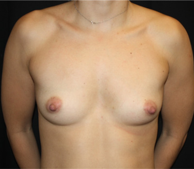 Breast Augmentation - Round Silicone Implants Before & After Patient #25608
