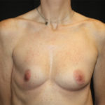 Breast Augmentation - Round Silicone Implants Before & After Patient #25615