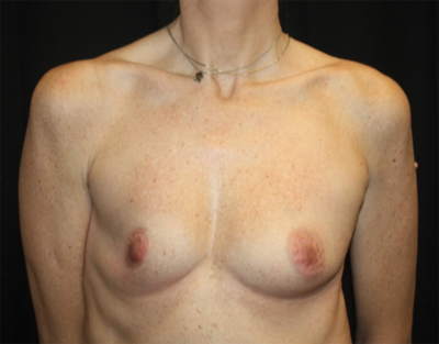 Breast Augmentation - Round Silicone Implants Before & After Patient #25615