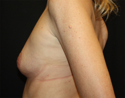 Breast Augmentation - Round Silicone Implants Before & After Patient #25615