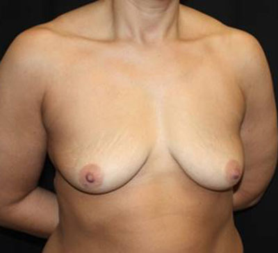 Breast Lift with Implant Before & After Patient #26816