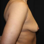 Breast Lift with Implant Before & After Patient #26816