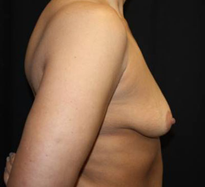 Breast Lift with Implant Before & After Patient #26816