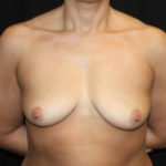 Breast Lift with Implant Before & After Patient #26816