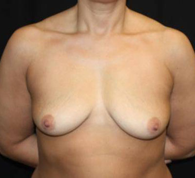 Breast Lift with Implant Before & After Patient #26816