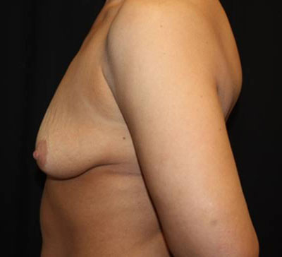 Breast Lift with Implant Before & After Patient #26816