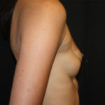Breast Augmentation - Round Silicone Implants Before & After Patient #25626
