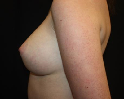 Breast Augmentation - Round Silicone Implants Before & After Patient #25637