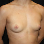 Breast Augmentation - Round Silicone Implants Before & After Patient #25649