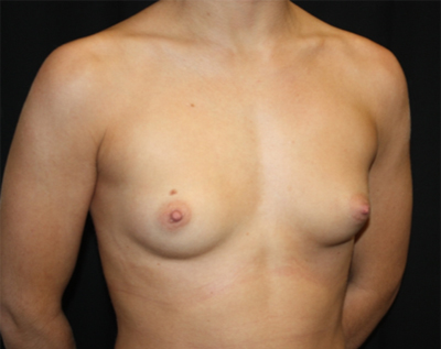 Breast Augmentation - Round Silicone Implants Before & After Patient #25649