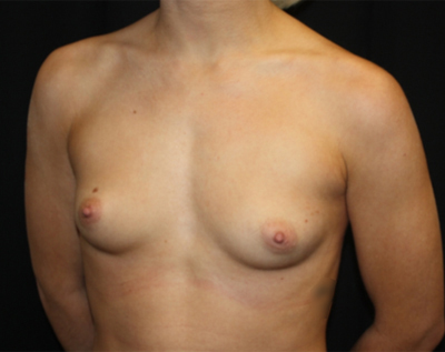 Breast Augmentation - Round Silicone Implants Before & After Patient #25649