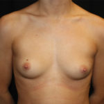 Breast Augmentation - Round Silicone Implants Before & After Patient #25649