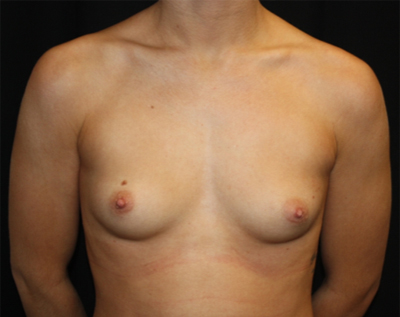 Breast Augmentation - Round Silicone Implants Before & After Patient #25649