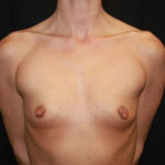 Breast Augmentation - Round Silicone Implants Before & After Patient #25671