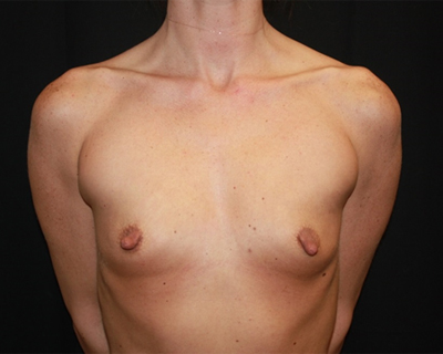 Breast Augmentation - Round Silicone Implants Before & After Patient #25671