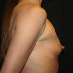 Breast Augmentation - Round Silicone Implants Before & After Patient #25671