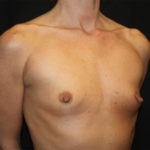 Breast Augmentation - Round Silicone Implants Before & After Patient #25671