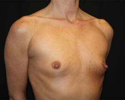 Breast Augmentation - Round Silicone Implants Before & After Patient #25671