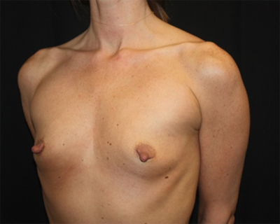 Breast Augmentation - Round Silicone Implants Before & After Patient #25671