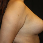 Breast Lift with Implant Before & After Patient #26849