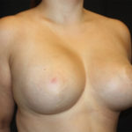 Breast Lift with Implant Before & After Patient #26849