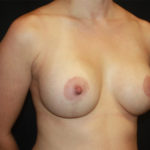 Breast Lift with Implant Before & After Patient #26858