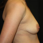 Breast Lift with Implant Before & After Patient #26858