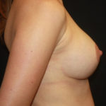 Breast Lift with Implant Before & After Patient #26858