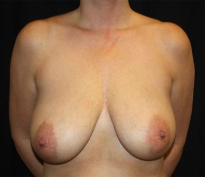 Breast Lift with Implant Before & After Patient #26869