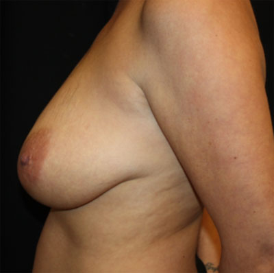 Breast Lift with Implant Before & After Patient #26869