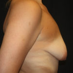 Breast Lift with Implant Before & After Patient #26880