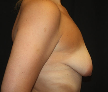 Breast Lift with Implant Before & After Patient #26880