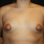 Breast Lift with Implant Before & After Patient #26891
