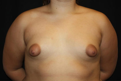 Breast Lift with Implant Before & After Patient #26891