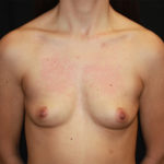 Breast Augmentation - Round Silicone Implants Before & After Patient #25682
