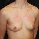 Breast Augmentation - Round Silicone Implants Before & After Patient #25682