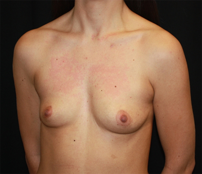 Breast Augmentation - Round Silicone Implants Before & After Patient #25682