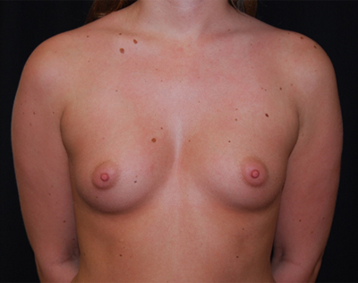 Breast Augmentation - Shaped Silicone Implants Before & After Patient #26362