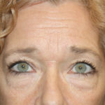 Blepharoplasty and Brow Lift Before & After Patient #25372