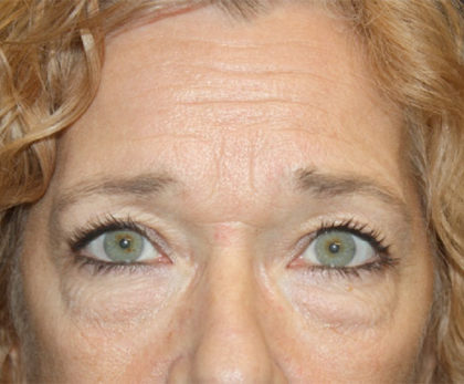 Blepharoplasty and Brow Lift Before & After Patient #25372