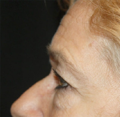 Blepharoplasty and Brow Lift Before & After Patient #25372