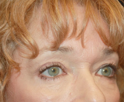 Blepharoplasty and Brow Lift Before & After Patient #25372