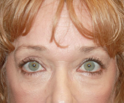 Blepharoplasty and Brow Lift Before & After Patient #25372