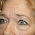 Blepharoplasty and Brow Lift Before & After Patient #25372