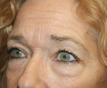 Blepharoplasty and Brow Lift Before & After Patient #25372